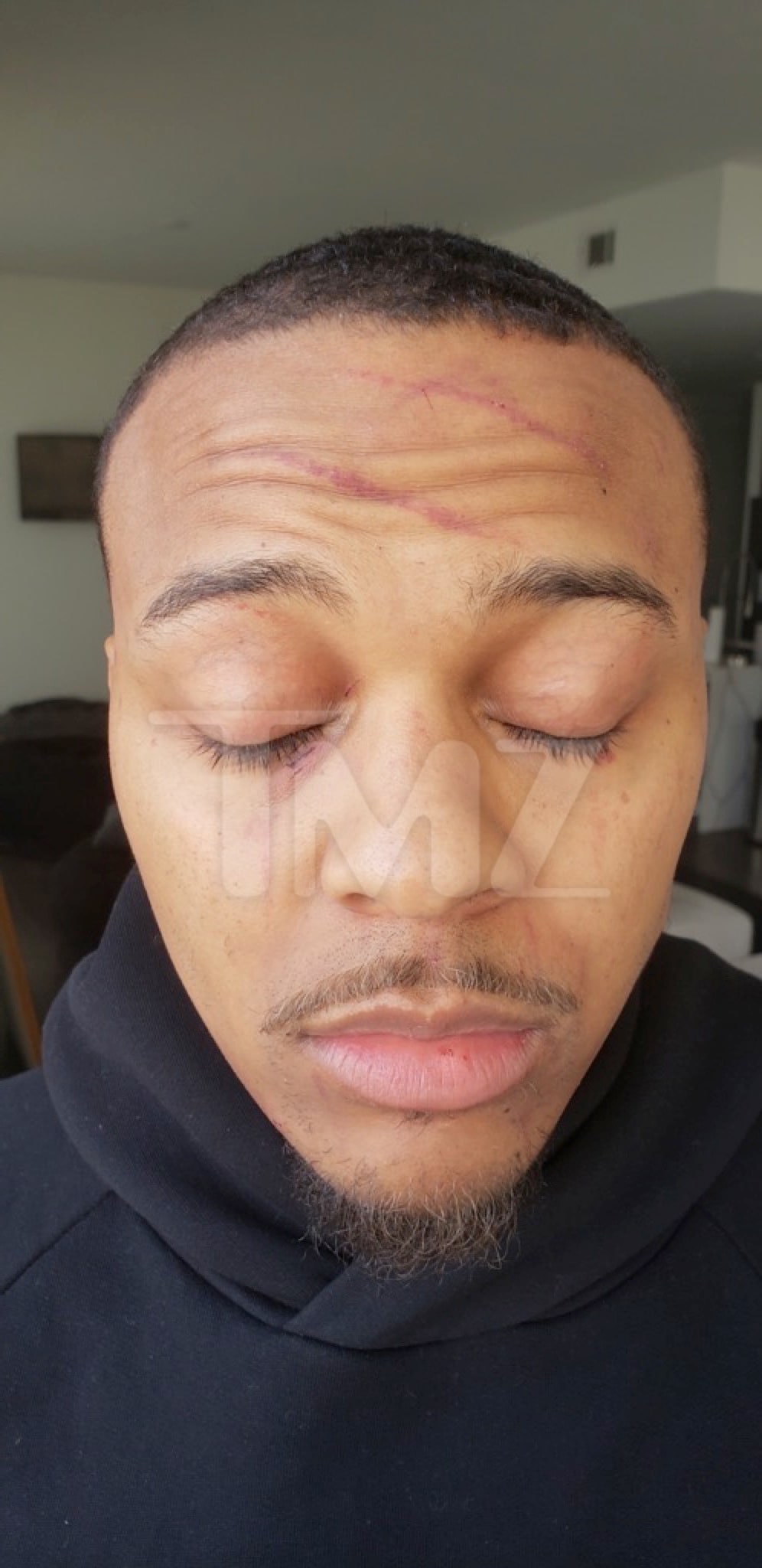 Bow Wow Domestic Violence Injuries